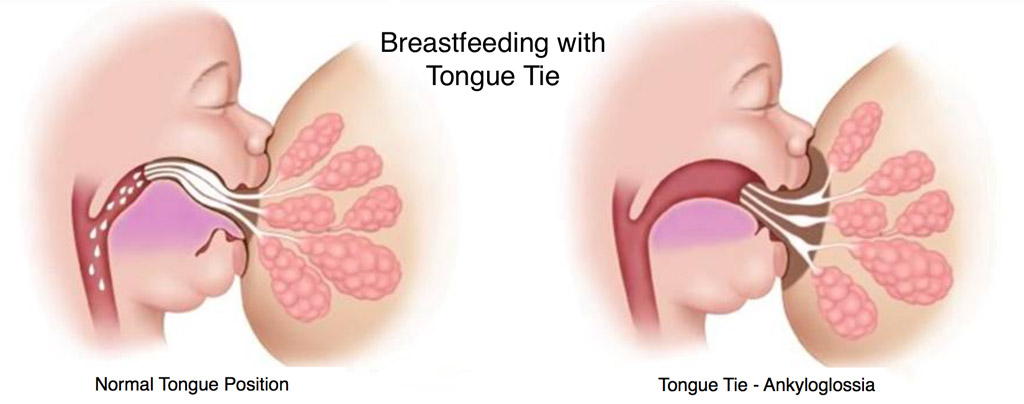 Breastfeeding with Tongue Tie.jpeg